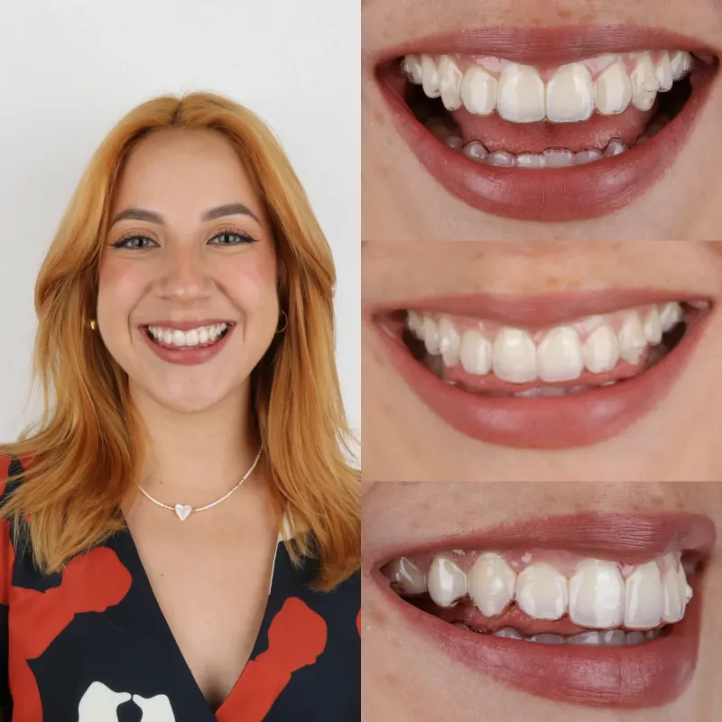 Ortodoncia Invisible