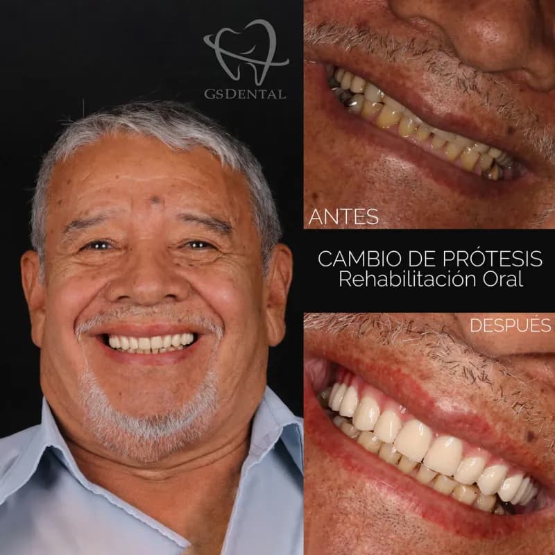Rehabilitación Dental