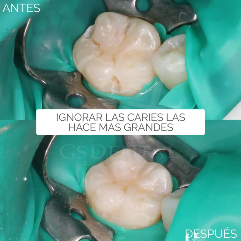 Restauración Dental